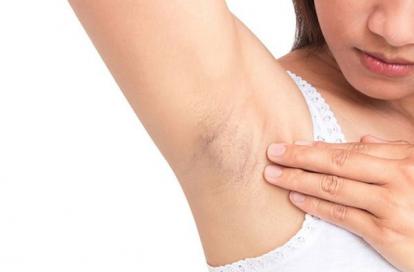 5 Thói quen khiến da vùng nách thâm đen